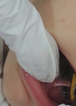 Exploración del frenillo